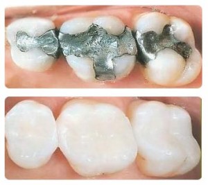 Dental White Fillings New Eltham, London | Replacing Amalgam Fillings ✓