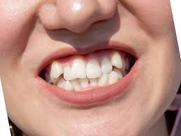 The Dangers Of Shifting Teeth And What You Can Do About It