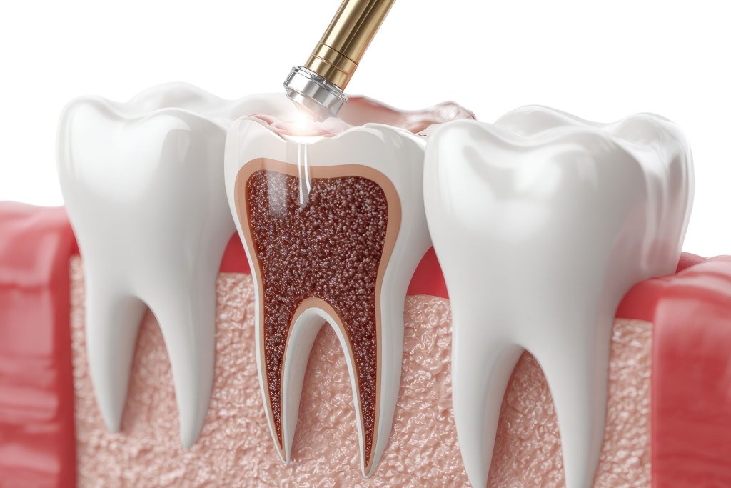Root Canal Treatment in Eltham